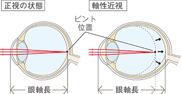 正規の状態 軸性近視